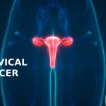 Cervical Cancer-KareOptions
