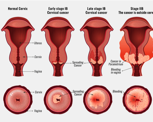 Stages-of-cervical-cancer