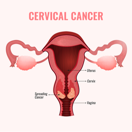 cervix-cancer