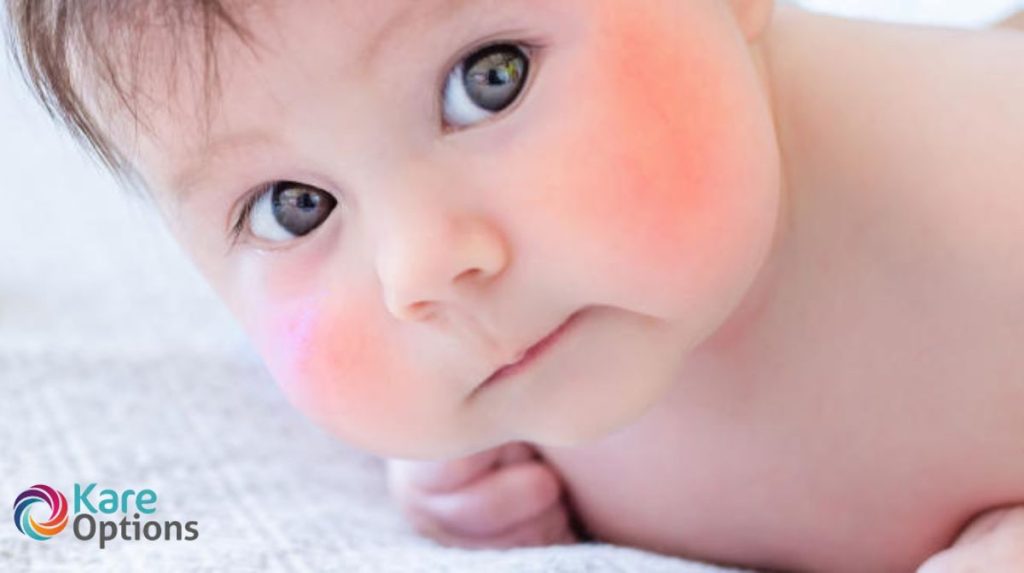 Fifth Disease in Children Causes, Symptoms and Treatment Health and